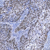 IHC staining of FFPE human larynx squamous cell carcinoma tissue with SAP130 antibody. HIER: boil tissue sections in pH8 EDTA for 20 min and allow to cool before testing.