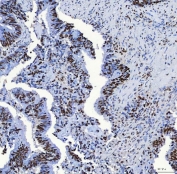 IHC staining of FFPE human colon adenocarcinoma tissue with SAP130 antibody. HIER: boil tissue sections in pH8 EDTA for 20 min and allow to cool before testing.