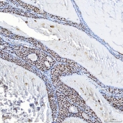 IHC staining of FFPE human breast cancer tissue with SAP130 antibody. HIER: boil tissue sections in pH8 EDTA for 20 min and allow to cool before testing.