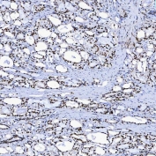 IHC staining of FFPE human prostate adenocarcinoma tissue with SAP130 antibody. HIER: boil tissue sections in pH8 EDTA for 20 min and allow to cool before testing.