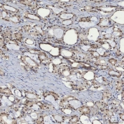 IHC staining of FFPE human prostate adenocarcinoma tissue with mSin3A antibody. HIER: boil tissue sections in pH8 EDTA for 20 min and allow to cool before testing.