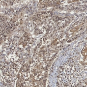 IHC staining of FFPE human larynx squamous cell carcinoma tissue with mSin3A antibody. HIER: boil tissue sections in pH8 EDTA for 20 min and allow to cool before testing.