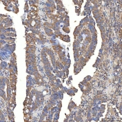 IHC staining of FFPE human colon adenocarcinoma tissue with SLC20A1 antibody. HIER: boil tissue sections in pH8 EDTA for 20 min and allow to cool before testing.