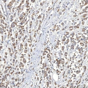 IHC staining of FFPE human breast cancer tissue with SLC20A1 antibody. HIER: boil tissue sections in pH8 EDTA for 20 min and allow to cool before testing.