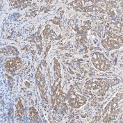 IHC staining of FFPE human lung adenocarcinoma tissue with SLC20A1 antibody. HIER: boil tissue sections in pH8 EDTA for 20 min and allow to cool before testing.