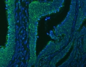 Immunofluorescent staining of FFPE human rectal cancer tissue with SLC20A1 antibody (green) and DAPI nuclear stain (blue). HIER: steam section in pH6 citrate buffer for 20 min.