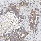 IHC staining of FFPE human ovary serous carcinoma tissue with SLC20A1 antibody. HIER: boil tissue sections in pH8 EDTA for 20 min and allow to cool before testing.