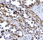 IHC staining of FFPE human ovarian cancer tissue with Transcription factor SP1 antibody. HIER: boil tissue sections in pH8 EDTA for 20 min and allow to cool before testing.