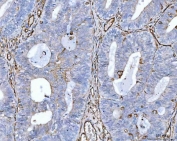 IHC staining of FFPE human endometrial adenocarcinoma tissue with CD105 antibody. HIER: boil tissue sections in pH8 EDTA for 20 min and allow to cool before testing.