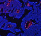 Immunofluorescent staining of FFPE human ovarian cancer tissue with CD105 antibody (red) and DAPI nuclear stain (blue). HIER: steam section in pH8 EDTA buffer for 20 min.