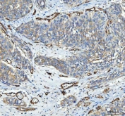 IHC staining of FFPE human bladder urothelial carcinoma tissue with CD105 antibody. HIER: boil tissue sections in pH8 EDTA for 20 min and allow to cool before testing.