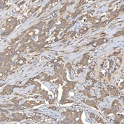 IHC staining of FFPE human breast cancer tissue with SIAE antibody. HIER: boil tissue sections in pH8 EDTA for 20 min and allow to cool before testing.