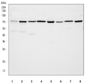 IHC staining of FFPE human breast cancer tissue with SIAE antibody. HIER: boil tissue sections in pH8 EDTA for 20 min and allow to cool before testing.