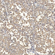 IHC staining of FFPE human lung adenocarcinoma tissue with SIAE antibody. HIER: boil tissue sections in pH8 EDTA for 20 min and allow to cool before testing.