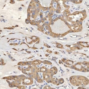 IHC staining of FFPE human right renal oncocytoma tissue with SIAE antibody. HIER: boil tissue sections in pH8 EDTA for 20 min and allow to cool before testing.