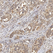 IHC staining of FFPE human appendix adenocarcinoma tissue with SIAE antibody. HIER: boil tissue sections in pH8 EDTA for 20 min and allow to cool before testing.