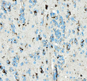 IHC staining of FFPE human colon adenocarcinoma tissue with SIAE antibody. HIER: boil tissue sections in pH8 EDTA for 20 min and allow to cool before testing.