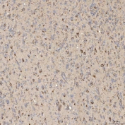 IHC staining of FFPE human glioblastoma tissue with SIAE antibody. HIER: boil tissue sections in pH8 EDTA for 20 min and allow to cool before testing.