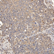 IHC staining of FFPE human esophageal squamous carcinoma tissue with SIAE antibody. HIER: boil tissue sections in pH8 EDTA for 20 min and allow to cool before testing.