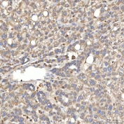 IHC staining of FFPE human liver cancer tissue with SIAE antibody. HIER: boil tissue sections in pH8 EDTA for 20 min and allow to cool before testing.