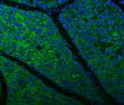 Immunofluorescent staining of FFPE human liver cancer tissue with Citrin antibody (green) and DAPI nuclear stain (blue). HIER: steam section in pH8 EDTA buffer for 20 min.
