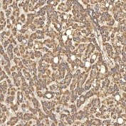IHC staining of FFPE human liver cancer tissue with Citrin antibody. HIER: boil tissue sections in pH8 EDTA for 20 min and allow to cool before testing.