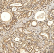 IHC staining of FFPE human prostate adenocarcinoma tissue with Citrin antibody. HIER: boil tissue sections in pH8 EDTA for 20 min and allow to cool before testing.