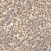 IHC staining of FFPE human diffuse large B cell lymphoma tissue with Citrin antibody. HIER: boil tissue sections in pH8 EDTA for 20 min and allow to cool before testing.