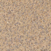 IHC staining of FFPE human breast cancer tissue with Citrin antibody. HIER: boil tissue sections in pH8 EDTA for 20 min and allow to cool before testing.