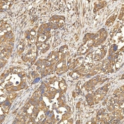 IHC staining of FFPE human appendix adenocarcinoma tissue with Citrin antibody. HIER: boil tissue sections in pH8 EDTA for 20 min and allow to cool before testing.