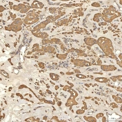 IHC staining of FFPE human right renal oncocytoma tissue with Citrin antibody. HIER: boil tissue sections in pH8 EDTA for 20 min and allow to cool before testing.