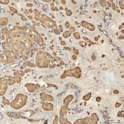 IHC staining of FFPE human right renal oncocytoma tissue with Thiosulfate sulfurtransferase antibody. HIER: boil tissue sections in pH8 EDTA for 20 min and allow to cool before testing.