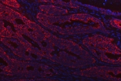 Immunofluorescent staining of FFPE human lung cancer tissue with Thiosulfate sulfurtransferase antibody (red) and DAPI nuclear stain (blue). HIER: steam section in pH8 EDTA buffer for 20 min.
