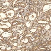 IHC staining of FFPE human prostate adenocarcinoma tissue with Thiosulfate sulfurtransferase antibody. HIER: boil tissue sections in pH8 EDTA for 20 min and allow to cool before testing.