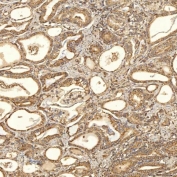 IHC staining of FFPE human prostate adenocarcinoma tissue with Thiosulfate sulfurtransferase antibody. HIER: boil tissue sections in pH8 EDTA for 20 min and allow to cool before testing.