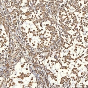 IHC staining of FFPE human lung adenocarcinoma tissue with Thiosulfate sulfurtransferase antibody. HIER: boil tissue sections in pH8 EDTA for 20 min and allow to cool before testing.