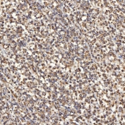 IHC staining of FFPE human diffuse large B-cell lymphoma tissue with Thiosulfate sulfurtransferase antibody. HIER: boil tissue sections in pH8 EDTA for 20 min and allow to cool before testing.