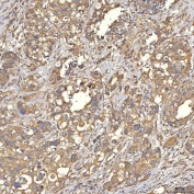 IHC staining of FFPE human appendix adenocarcinoma tissue with Thiosulfate sulfurtransferase antibody. HIER: boil tissue sections in pH8 EDTA for 20 min and allow to cool before testing.