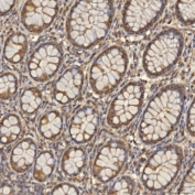 IHC staining of FFPE human colon adenocarcinoma tissue with Thiosulfate sulfurtransferase antibody. HIER: boil tissue sections in pH8 EDTA for 20 min and allow to cool before testing.