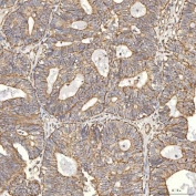 IHC staining of FFPE human endometrioid adenocarcinoma tissue with Thiosulfate sulfurtransferase antibody. HIER: boil tissue sections in pH8 EDTA for 20 min and allow to cool before testing.