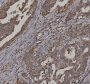 IHC staining of FFPE human colorectal adenocarcinoma tissue with FATP-3 antibody. HIER: boil tissue sections in pH8 EDTA for 20 min and allow to cool before testing.