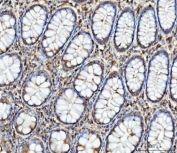 IHC staining of FFPE human rectum adenocarcinoma tissue with FATP-4 antibody. HIER: boil tissue sections in pH8 EDTA for 20 min and allow to cool before testing.