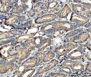 IHC staining of FFPE human prostatic carcinoma tissue with FATP-4 antibody. HIER: boil tissue sections in pH8 EDTA for 20 min and allow to cool before testing.