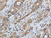 IHC staining of FFPE human colorectal adenocarcinoma tissue with FATP-4 antibody. HIER: boil tissue sections in pH8 EDTA for 20 min and allow to cool before testing.
