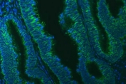 Immunofluorescent staining of FFPE human colon cancer tissue with TXNDC5 antibody (green) and DAPI nuclear stain (blue). HIER: steam section in pH6 citrate buffer for 20 min.