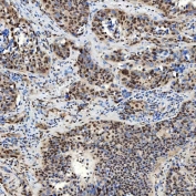 IHC staining of FFPE human urothelial carcinoma tissue with SNF2L2 antibody. HIER: boil tissue sections in pH8 EDTA for 20 min and allow to cool before testing.