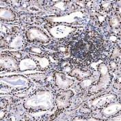 IHC staining of FFPE human prostate adenocarcinoma tissue with SNF2L2 antibody. HIER: boil tissue sections in pH8 EDTA for 20 min and allow to cool before testing.