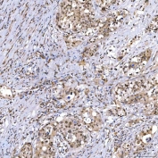 IHC staining of FFPE human appendix adenocarcinoma tissue with SNF2L2 antibody. HIER: boil tissue sections in pH8 EDTA for 20 min and allow to cool before testing.