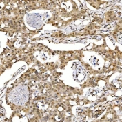 IHC staining of FFPE human breast cancer tissue with SNF2L2 antibody. HIER: boil tissue sections in pH8 EDTA for 20 min and allow to cool before testing.