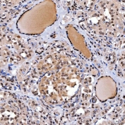IHC staining of FFPE human thyroid papillary carcinoma tissue with SNF2L2 antibody. HIER: boil tissue sections in pH8 EDTA for 20 min and allow to cool before testing.